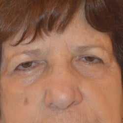 Before Image: Upper Blepharoplasty by Dr. Thompson - front