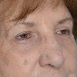 After Image: Upper Blepharoplasty by Dr. Thompson - right-front-oblique