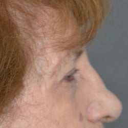After Image: Upper Blepharoplasty by Dr. Thompson - right-side