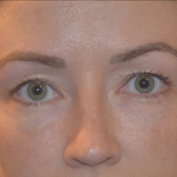 After Image: Peri-orbital Fat Injections by Dr. Thompson - front