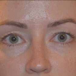 Before Image: Peri-orbital Fat Injections by Dr. Thompson - front