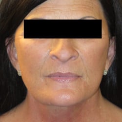 After Image: Facelift and Fat Grafting by Dr. Thompson - front