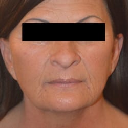 Before Image: Facelift and Fat Grafting by Dr. Thompson - front