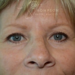 After Image: Upper Blepharoplasty (Eyelid Surgery) – 676 - front