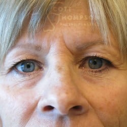 Before Image: Upper Blepharoplasty (Eyelid Surgery) – 676 - front