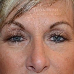 After Image: Upper Blepharoplasty by Dr. Thompson - front