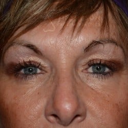 Before Image: Upper Blepharoplasty by Dr. Thompson - front