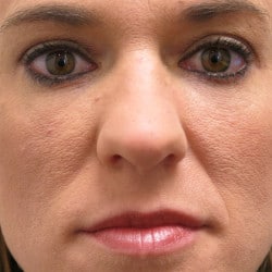 After Image: Lower Blepharoplasty by Dr. Henstrom - front