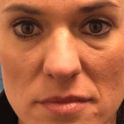 Before Image: Lower Blepharoplasty by Dr. Henstrom - front