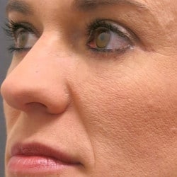 After Image: Lower Blepharoplasty by Dr. Henstrom - left-front-oblique
