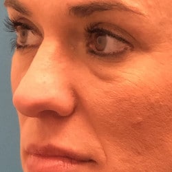 Before Image: Lower Blepharoplasty by Dr. Henstrom - left-front-oblique