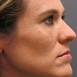 After Image: Lower Blepharoplasty by Dr. Henstrom - right-side