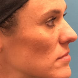 Before Image: Lower Blepharoplasty by Dr. Henstrom - right-side