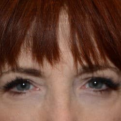 After Image: Upper Eyelid Surgery | Lower Eyelid Surgery with Fat Repositioning – 699 - front