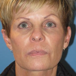 After Image: Macslift, Perioral Dermabrasion, Upper Blepharoplasty by Dr. Henstrom - front