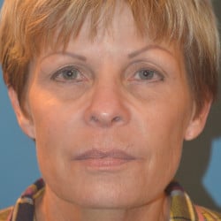 Before Image: Macslift, Perioral Dermabrasion, Upper Blepharoplasty by Dr. Henstrom - front