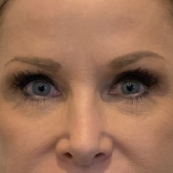 After Image: Upper Blepharoplasty, Lower Lid Skin Pinch, & Periorbital Fat Injections by Dr. Thompson - front