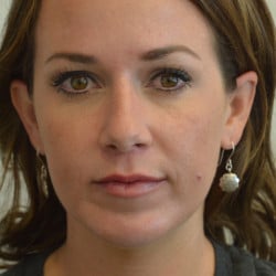 After Image: Rhinoplasty, Chin Implant, Lip Lift by Dr. Thompson - front