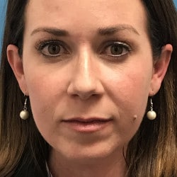 Before Image: Rhinoplasty, Chin Implant, Lip Lift by Dr. Thompson - front