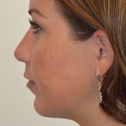 After Image: Rhinoplasty, Chin Implant, Lip Lift by Dr. Thompson - left-side