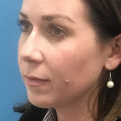 Before Image: Rhinoplasty, Chin Implant, Lip Lift by Dr. Thompson - left-front-oblique