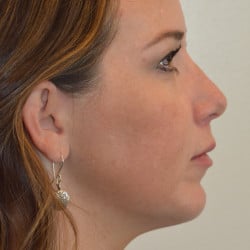 After Image: Rhinoplasty, Chin Implant, Lip Lift by Dr. Thompson - right-side