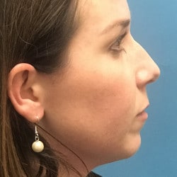 Before Image: Rhinoplasty, Chin Implant, Lip Lift by Dr. Thompson - right-side