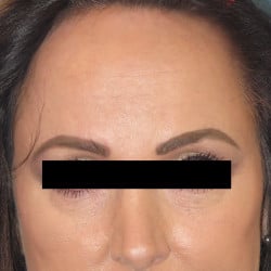 Forehead Reduction by Dr. Thompson