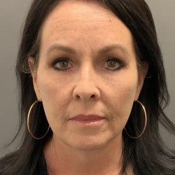 After Image: Facelift, Upper & Lower Blepharoplasty by Dr. Thompson