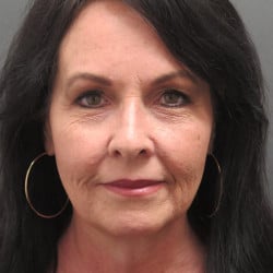 Before Image: Facelift, Upper & Lower Blepharoplasty by Dr. Thompson