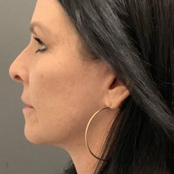 After Image: Facelift, Upper & Lower Blepharoplasty by Dr. Thompson - other