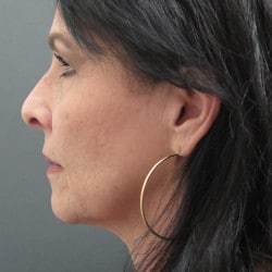 Before Image: Facelift, Upper & Lower Blepharoplasty by Dr. Thompson - other