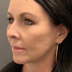 After Image: Facelift, Upper & Lower Blepharoplasty by Dr. Thompson - left-front-oblique