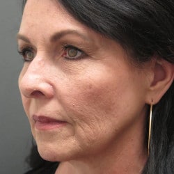 Before Image: Facelift, Upper & Lower Blepharoplasty by Dr. Thompson - left-front-oblique