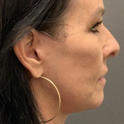 After Image: Facelift, Upper & Lower Blepharoplasty by Dr. Thompson - right-side