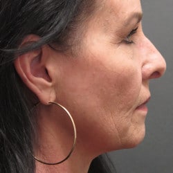 Before Image: Facelift, Upper & Lower Blepharoplasty by Dr. Thompson - right-side