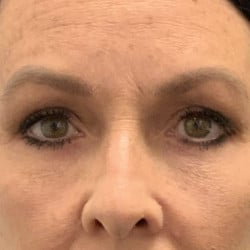After Image: Upper & Lower Blepharoplasty by Dr. Thompson - front