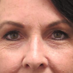 Before Image: Upper & Lower Blepharoplasty by Dr. Thompson - front