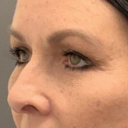After Image: Upper & Lower Blepharoplasty by Dr. Thompson - left-front-oblique