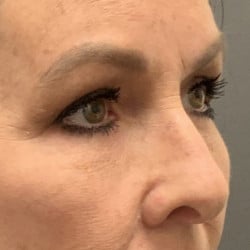 After Image: Upper & Lower Blepharoplasty by Dr. Thompson - right-front-oblique