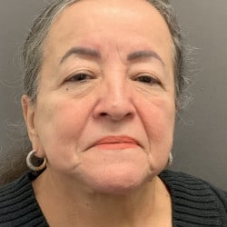 After Image: Facelift by Dr. Henstrom - front