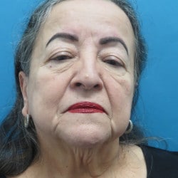 Before Image: Facelift by Dr. Henstrom - front
