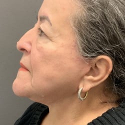 After Image: Facelift by Dr. Henstrom - left-side