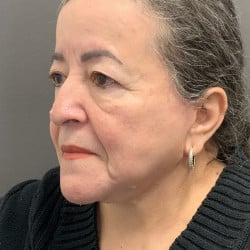 After Image: Facelift by Dr. Henstrom - left-front-oblique