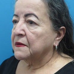 Before Image: Facelift by Dr. Henstrom - left-front-oblique