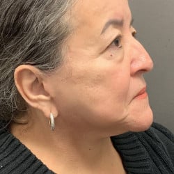 After Image: Facelift by Dr. Henstrom - right-side