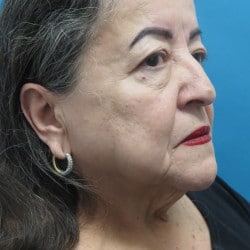 Before Image: Facelift by Dr. Henstrom - right-side