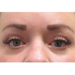 After Image: Upper & Lower Blepharoplasty by Dr. Henstrom - front