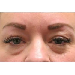 Before Image: Upper & Lower Blepharoplasty by Dr. Henstrom - front