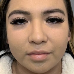 After Image: Rhinoplasty & Chin Implant by Dr. Thompson - front